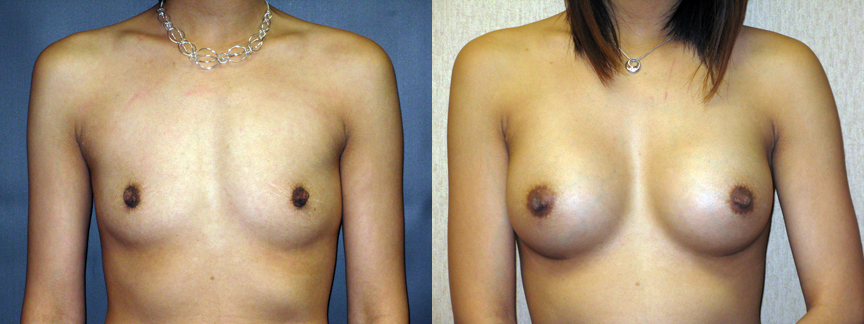 Nac Ratio Breast Lift Vs Breast Augmentation 56