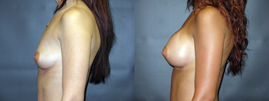 Nac Ratio Breast Lift Vs Breast Augmentation 87
