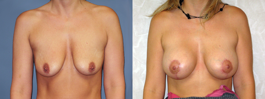 Nac Ratio Breast Lift Vs Breast Augmentation 54