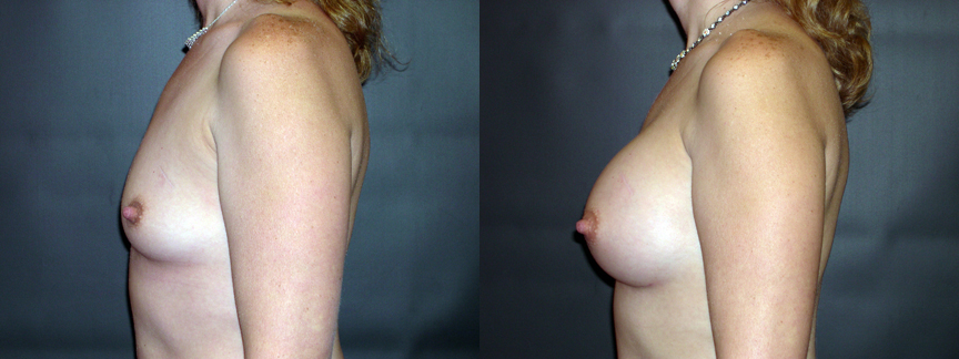 Nac Ratio Breast Lift Vs Breast Augmentation 105