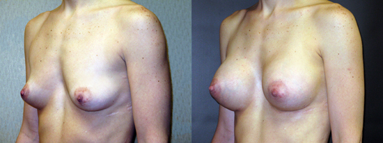 Nac Ratio Breast Lift Vs Breast Augmentation 32